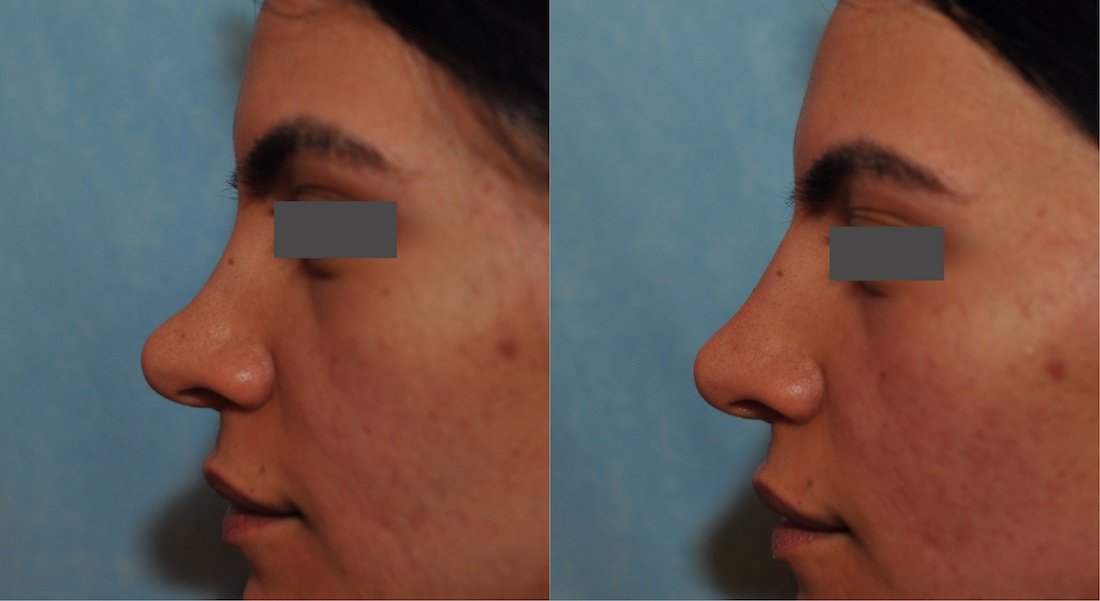 rhinoplastie sans chirurgie
