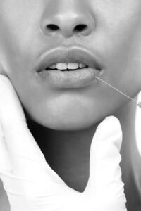 injections levres avis