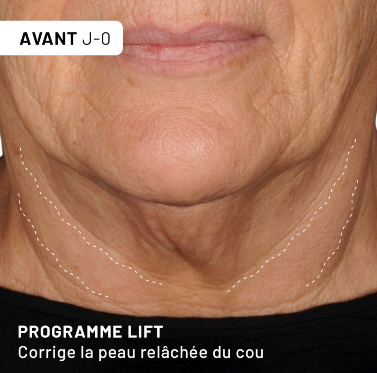 double menton astuce
