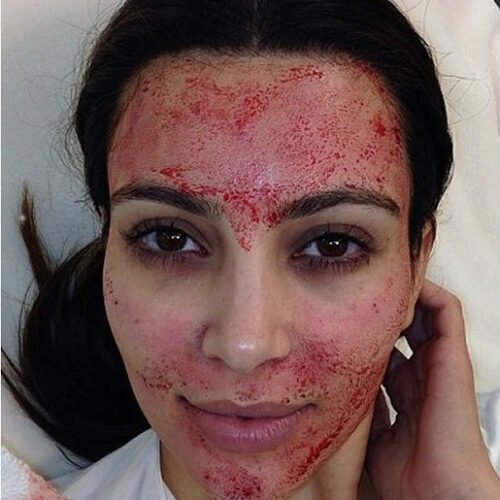 Kim-Kardashian-fait-un-Face-lift-Vampire-3