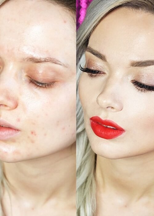 acne_makeup_before_after